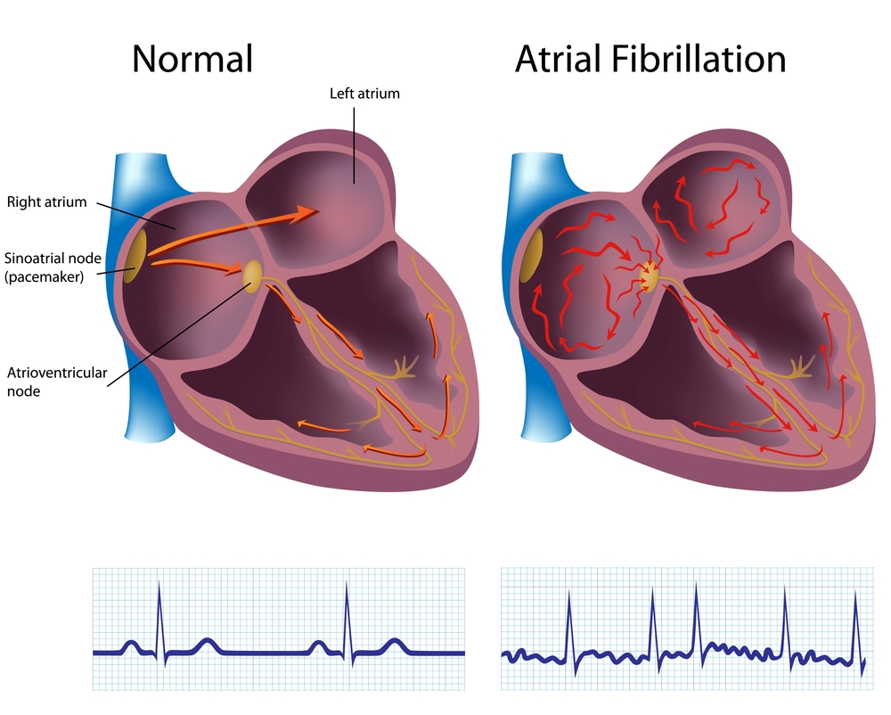 Atiral Fibrilation.jpg